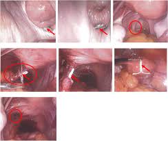 Algorithm for iud removal when no strings are visible. Retained Intrauterine Device Iud Triple Case Report And Review Of The Literature