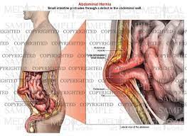 See abdominal muscle stock video clips. Abdominal Hernia Anatomy Of Male Lateral View Medical Art Works