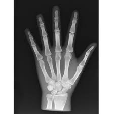 Image result for Hand XRay