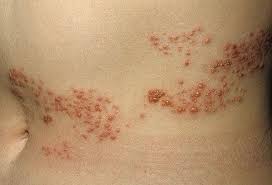 There are two types of hsv that can cause a skin rash in different areas: Pin On Aches And Pains