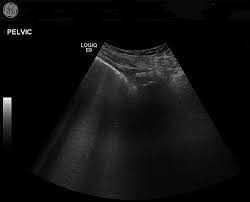 No Bladder Visible On Ultrasound Scan Has The Patient Had A Cystectomy A Case Of Emphysematous Cystitis Bmj Case Reports