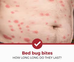 Bedbugs (or bed bugs) are small, oval, brownish insects that live on the blood of animals or humans. How Long Do Bed Bug Bites Last A Simple Guide Pest Strategies