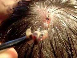 Ciri ciri terkena lalat botfly. Video Mengerikan Larva Lalat Tumbuh Besar Di Kepala Bocah Ini Halaman 1 Sriwijaya Post