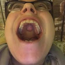 Most causes of a bump on this part of the body are easily. Recently Learned Not Everyone Has A Boneyards Bump On The Roof Of Their Mouth It S Called Torus Palatinus Mildlyinteresting