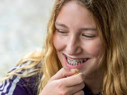 Once the braces come off, a retainer is worn to keep the teeth in place. What Is Orthodontic Headgear And How Does It Help Straighten Teeth