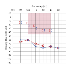 Maybe you would like to learn more about one of these? Air Conduction Vs Bone Conduction Candidacy Guide For Bone Conduction Systems Med El Professionals Blog