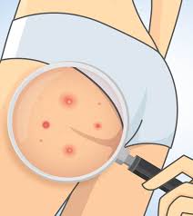 In fact, yeast infection pimples can form here because of sweat and heat. How To Get Rid Of Butt Acne Fast