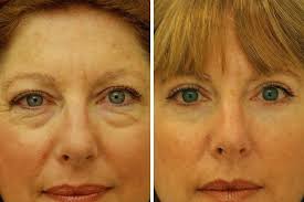 Eyelids Surgery Miami Dr Ramirez Plastic Surgeon Eye Lift Surgery Eyelid Surgery Best Plastic Surgeons
