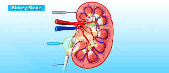 Kidney Stones Nephrolithiasis Boulder Medical Center