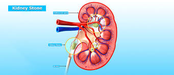 The paired kidneys are located between the twelfth thoracic and third lumbar vertebrae, one on each side of the vertebral column. Kidney Stones Nephrolithiasis Boulder Medical Center