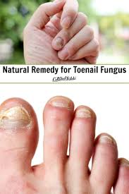 Since it is a fairly new home remedy, there is not much concrete proof of its the ingredient thymol which is present vicks vapor rub is thought to be the active ingredient for treating the toenail fungus. Natural Remedy For Toenail Fungus Cultured Palate