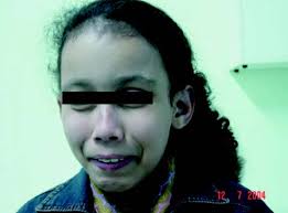 EARLY DIAGNOSIS OF THE UROFACIAL SYNDROME IS ESSENTIAL TO PREVENT  IRREVERSIBLE RENAL FAILURE