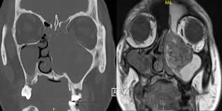 Image result for Maxillary Sinus