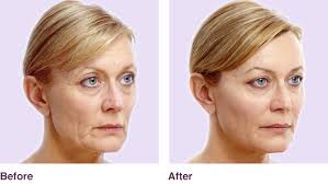 Learn more about the average costs of juvéderm treatments, and talk to your dermatologist about their fees. Secret Weapon To Fighting Signs Of Aging Dermal Fillers Dy Dermatology Center