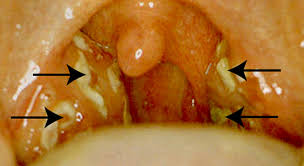 Bei schweren verläufen eines pfeifferschen drüsenfiebers kann es zur beteiligung des zentralen nervensystems kommen. Angina Mandelentzundung Tonsillitis