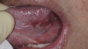 An increase in coronavirus sufferers displaying 'covid tongue' has prompted pleas for people to stay at home if they develop a skin rash, fatigue or headaches. Top 5 Oral Manifestations Of Covid 19 Perio Implant Advisory