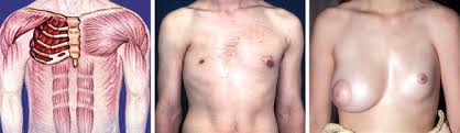 It usually affects half of the chest and presents associated abnormalities, of varying. Poland S Syndrome Springerlink