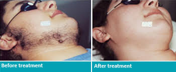 Laser hair removal is universally considered the most effective means of achieving permanent so if you're looking for laser hair removal near me, then the professionals at danik medspa can help. Laser Hair Removal Montclair Nj Permanent Hair Removal
