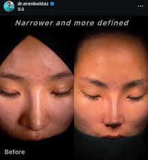 has anyone fitted a front nose skin is it a major job and what did you use  to seal the gaps