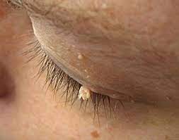 Skin tags on over eyelids are no different form skin tags in other parts of the face or in other parts of the neck to in the underarms. Skin Tags On Eyelids Weknoweyes Maple Grove Eye Doctors Pearle Vision