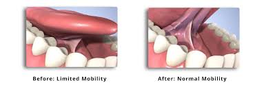 Frenectomy A Frenum Is A Fold Of Tissue In The Mouth Frenums Are Found Between The Upper Two Front Teeth Myofunctional Therapy Implant Dentist Dental Health