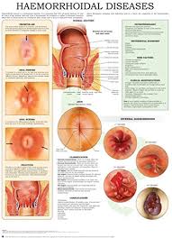 haemorrhoidal diseases e chart quick reference guide