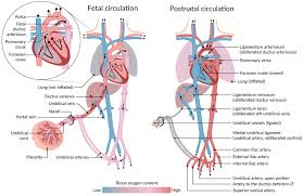 Image result for Delayed Transition from Fetal Circulation