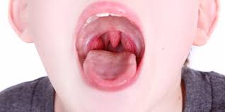 Together, the different parts of the tonsils form a ring where the mouth and nasal cavity meet the throat (th. 10 Remedies To Take Care Of Tonsillitis At Home