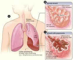 Nursing care plans helps nurses write customized care plans for their patients. Nursing Care Plan For Pneumonia With 11 Great Tips To Use
