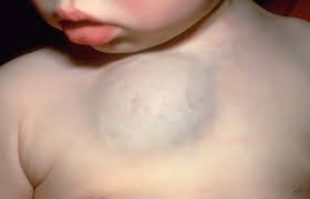 A change in your skin is the most common sign of skin cancer. Birthmarks Signs And Symptoms