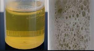 Jika air kencing anda masih berbuih walau pun anda ke tandas semasa pundi kencing tidak berapa penuh, maksudnya ada sesuatu yang tidak kena. Air Kencing Berbuih