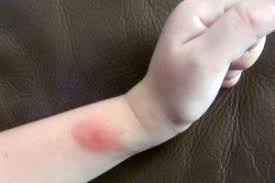Bug Bites That Look Like Mosquito Bites But Aren T Pin On Good For You