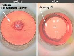 Image result for Cataract Extraction