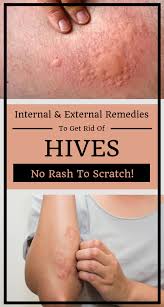 To say that hives are frustrating will be an understatement. Pin On Health Remedies