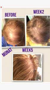 Helping To Change Lives Monat Is The Best Hair Care System For Thinning Or Aging Hair Out There Amazing A Monat Before And After Hair Loss Women Monat Hair