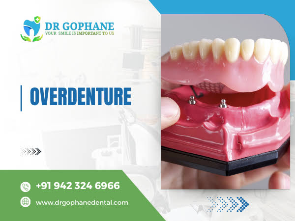 Overdenture Treatment In Yavatmal product image