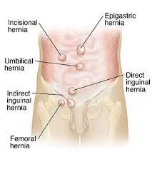 And some people may never need surgery for a small hernia. How To Treat Hernia In Ayurveda Hernia Treatment In Ayurveda