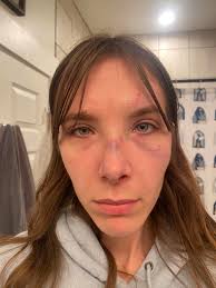 Local woman suffers severe injuries when attacked at downtown Pocatello bar 