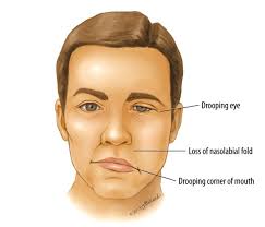 They may include muscle twitching, weakness, or total loss of the ability to move one, and in rare cases, both sides of the face. Everything About Bell S Palsy News Dentagama