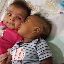 Baby's progress with breathing and vent support