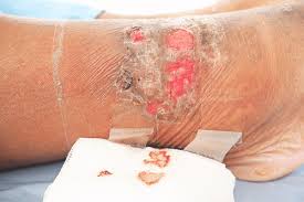 Check spelling or type a new query. Mrsa Types Causes Symptoms Treatment Protection Factdr