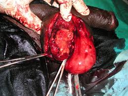 Maybe you would like to learn more about one of these? Fournier S Gangrene Intechopen
