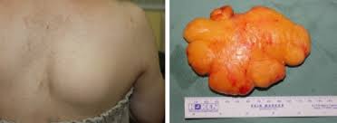 脂肪腫 Lipoma Japaneseclass Jp