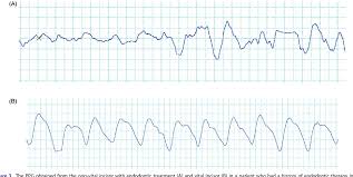 Figure 3 From Oxygen Saturation And Perfusion Index From