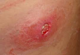 This is usually caused by shaving, application of the other hair removal methods and the friction from the clothing. 8 Boils Or Ingrown Hairs Ideas Ingrown Hair Underarm Hair Ingrown Hair Remedies