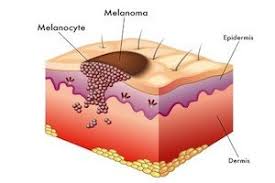 Cancer isn't the only illness that changes your appetite, but check with your doctor if you've had belly pain and bloating: Foot Melanoma The Hidden Danger Foot Healthcare Associates