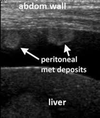 Ecr 2013 C 0081 Making The Most Of Bowel Imaging With Ultrasound What Radiologist That Scan Ultrasound Ultrasound Technician Diagnostic Medical Sonography