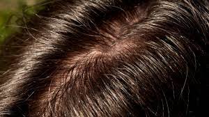 Some people with greasy hair may need to wash it every day. Do You Suffer From Oily Hair Or An Oily Scalp Mediceuticals