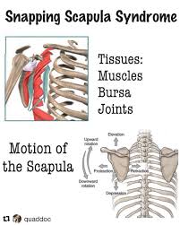 Image result for Snapping Scapula