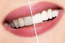 Karena gigi berfungsi sebagai pengunyah makanan tentu kinerja gigi akan selalu digunakan setiap hari, letak gigi yang. Berbagai Cara Memutihkan Gigi Melalui Perawatan Dokter